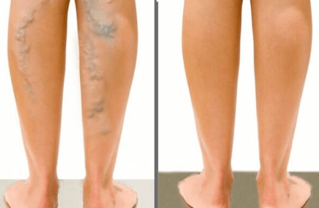 Veinas varices antes e despois da cirurxía