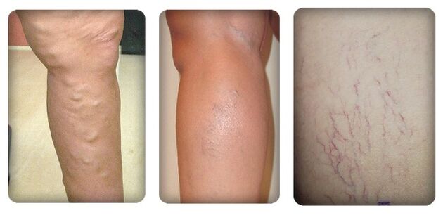 Etapas de varices