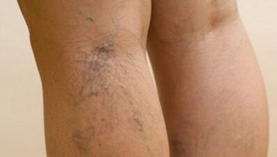As causas das varices