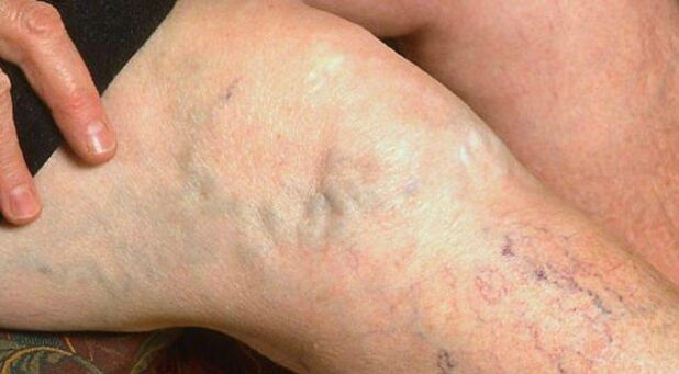Síntomas visibles de varices nas pernas