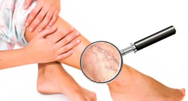 Varices nas pernas